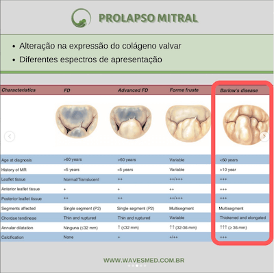 Classificação Prolapso Valvar Mitral Wavesmed