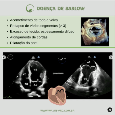 Doença de Barlow Prolapso Valvar Mitral Wavesmed