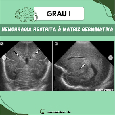 Grau I USG Hemorragia Ventricular Neonatal Wavesmed