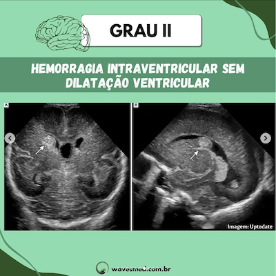 Grau II USG Hemorragia Ventricular Neonatal Wavesmed