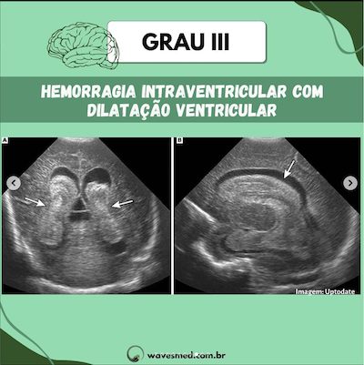 Grau III USG Hemorragia Ventricular Neonatal Wavesmed