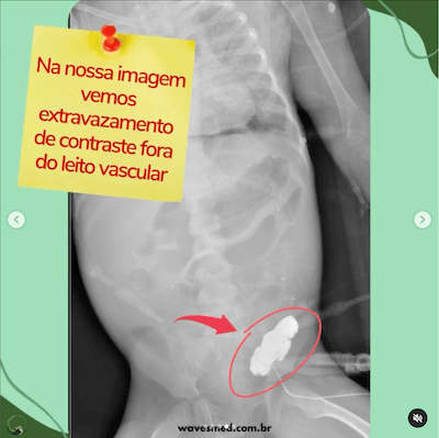 Complicação cateter venoso central pediatria Wavesmed