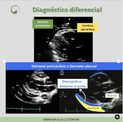 Diagnostico Diferencial Pericardite Aguda Derrame Pericárdico Wavesmed