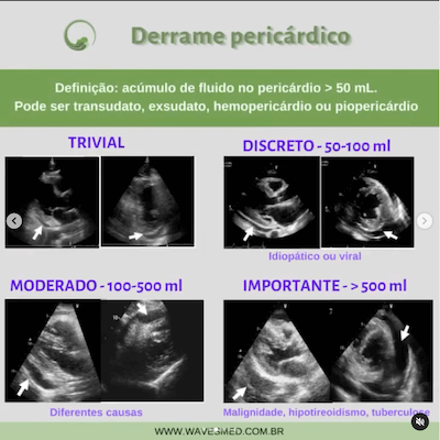 Definição pericardite aguda derrame pericárdico Wavesmed