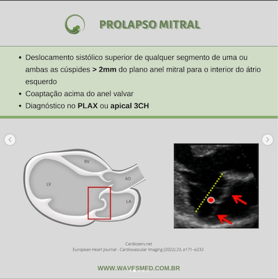 Definição prolapso da valva mitral Wavesmed