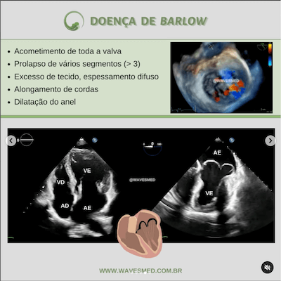 Segmentos prolapso da valva mitral Wavesmed