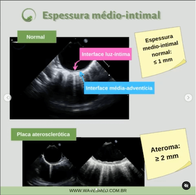 Espessura médio intimal aterosclerose aorta Wavesmed