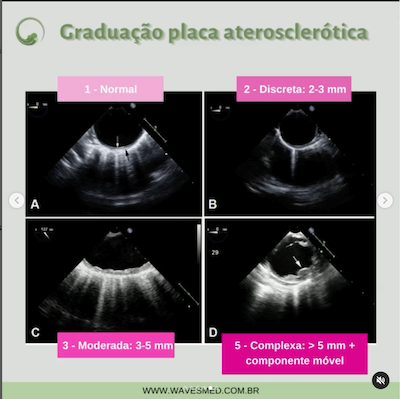 Graduação aterosclerose aorta Wavesmed