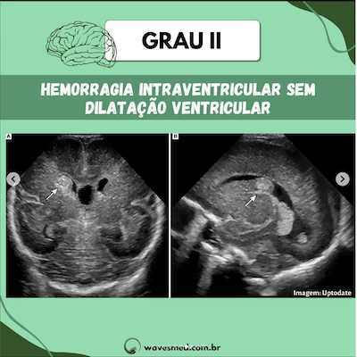 Grau II usg na hemorragia ventricular neonatal Wavesmed