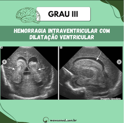 Grau III USG na hemorragia ventricular neonatal Wavesmed