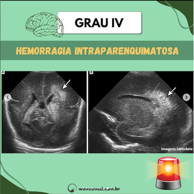 Grau IV USG na hemorragia ventricular neonatal Wavesmed