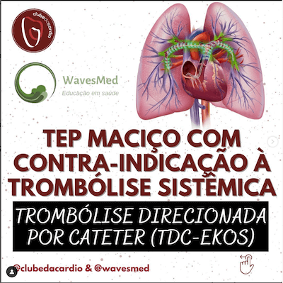 TEP maciço trombólise Wavesmed