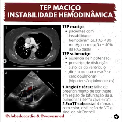 Instabilidade hemodinâmica TEP maciço trombólise Wavesmed