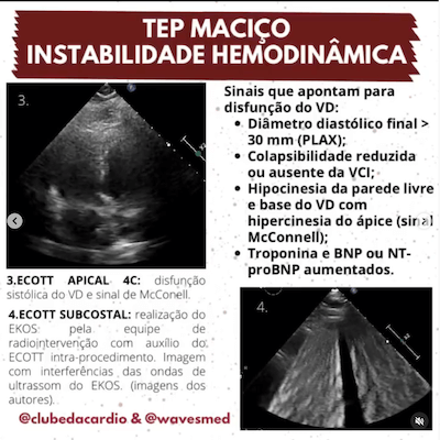 Mcconnell TEP maciço trombólise Wavesmed