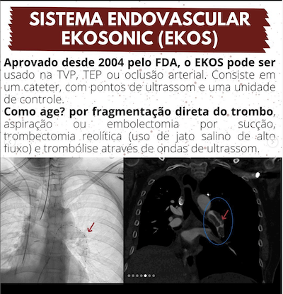 Ekosonic TEP maciço trombólise Wavesmed