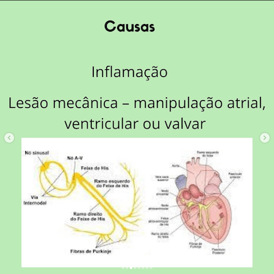 Causas arritmias pós operatório cardiopatias congênitas Wavesmed