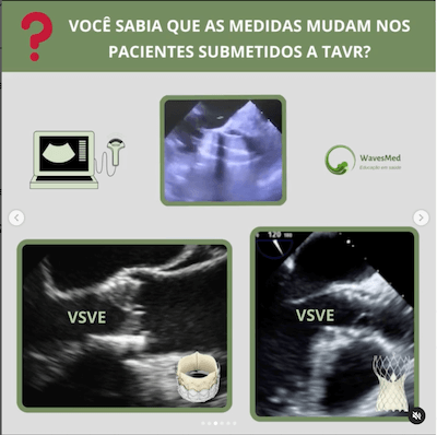 Medidas eco medida vsve pós tavr Wavesmed