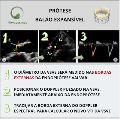 Balão expansível medida vsve pós tavr Wavesmed