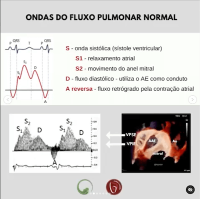 Ondas fluxo pulmonar avaliação veias pulmonares ecocardiograma Wavesmed