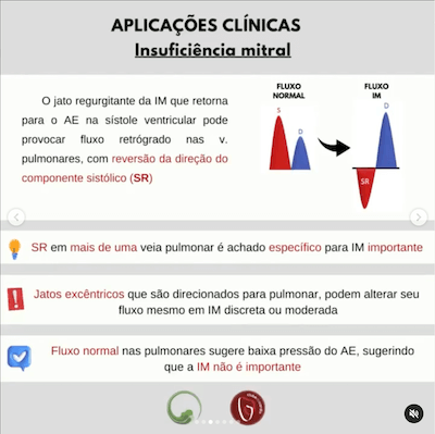 Insuficiência mitral avaliação veias pulmonares ecocardiograma Wavesmed