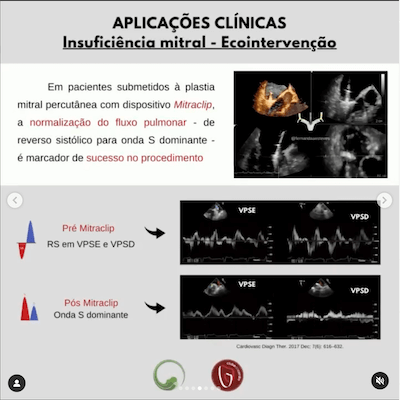 Intervenção insuficiência mitral avaliação veias pulmonares ecocardiograma Wavesmed