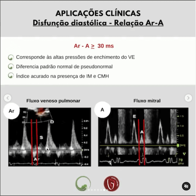 Disfunção diastólica avaliação veias pulmonares ecocardiograma Wavesmed