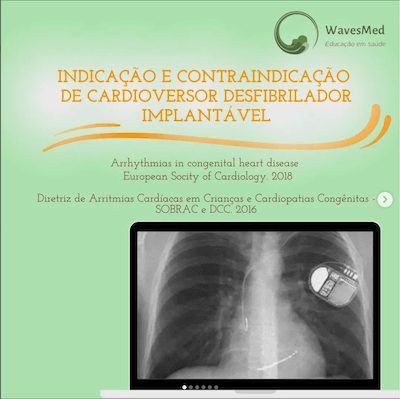 Cardioversor desfibrilador implantável cdi Wavesmed