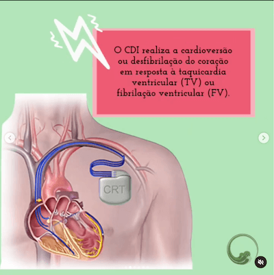 Definição cardioversor desfibrilador implantável cdi Wavesmed