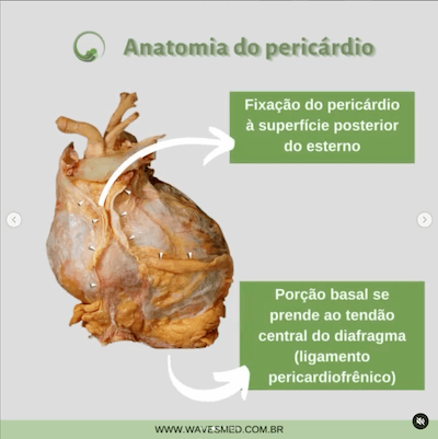 Fixação pericárdio anatomia pericárdio Wavesmed