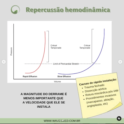 Repercussão hemodinâmica pericardite aguda derrame pericárdico Wavesmed