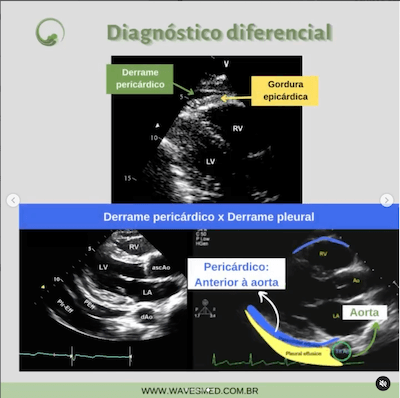 Diagnostico diferencial pericardite aguda derrame pericárdico Wavesmed