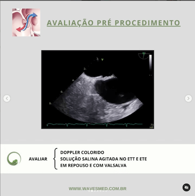 Avaliação pre procedimento oclusão percutânea forame oval patente wavesmed