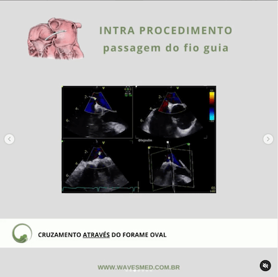 Intra procedimento oclusão percutânea forame oval patente Wavesmed