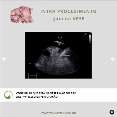 Intra procedimento oclusão percutânea forame oval patente Wavesmed