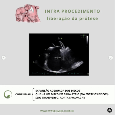 Liberação prótese oclusão percutânea forame oval patente Wavesmed