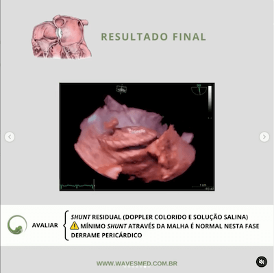 Resultado final oclusão percutânea forame oval patente Wavesmed