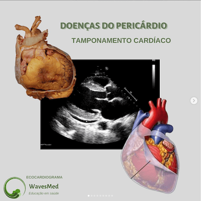 Tamponamento cardíaco Wavesmed