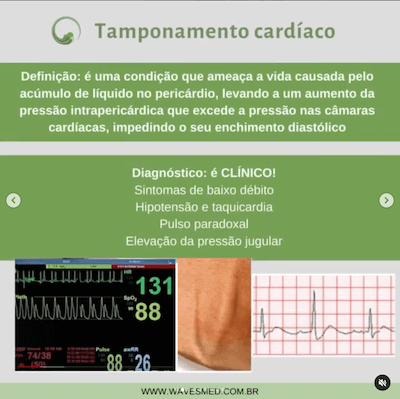 Definição tamponamento cardíaco Wavesmed