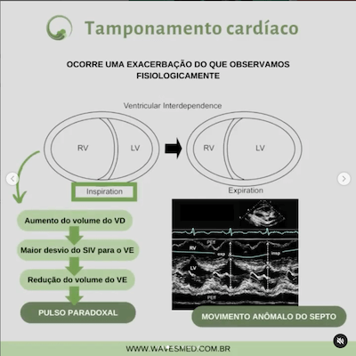 Movimento anômalo septo tamponamento cardíaco Wavesmed