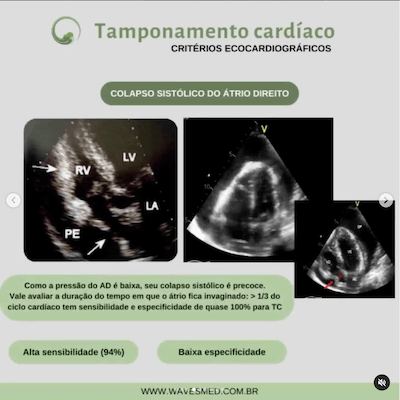 Colapso átrio direito tamponamento cardíaco Wavesmed