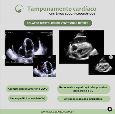 Colapso diastólico VD tamponamento cardíaco wavesmed