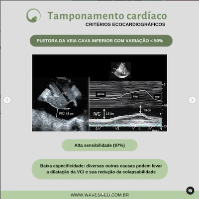 Pletora vci tamponamento cardíaco Wavesmed