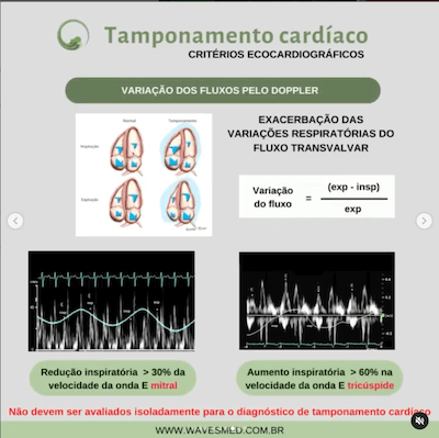 Fluxos doppler tamponamento cardíaco Wavesmed