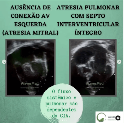 Atresia pulmonar CIA restritiva ECO Wavesmed