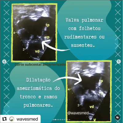 Morfologia tetralogia de fallot agenesia valva pulmonar Wavesmed