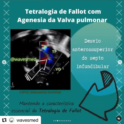 Desvio septo infundibular tetralogia de fallot agenesia valva pulmonar Wavesmed