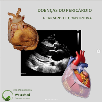 Pericardite constritiva Wavesmed