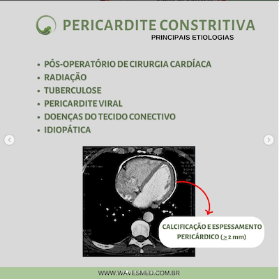 Etiologia pericardite constritiva Wavesmed