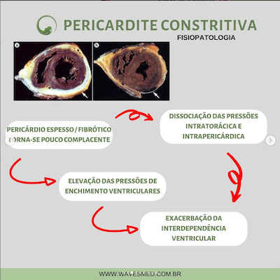 Fisiopatologia pericardite constritiva Wavesmed