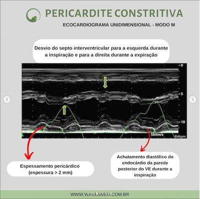 Ecocardiograma modo m pericardite constritiva Wavesmed